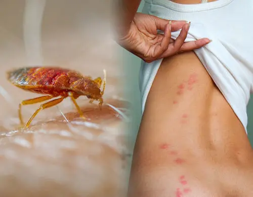 Bed bug bites on skin